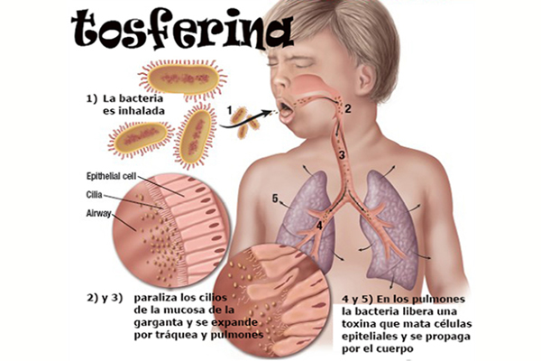 aumentan casos de tos-ferina